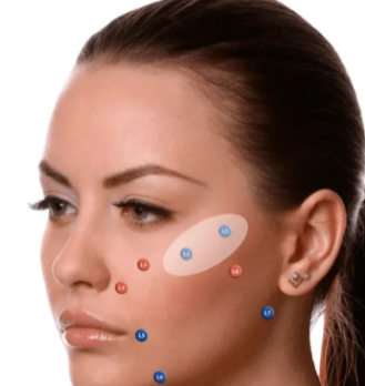 MD codes of hyaluronic acid injection